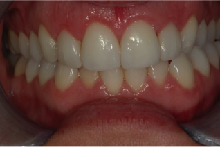 Cosmetic Crown Lengthening with Porcelain Veneers (Gummy Smile) - After