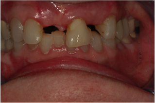 Dental Implants - Before
