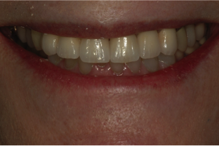 Dental Implants - After